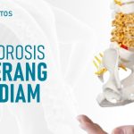 Penyakit Osteoporosis, Turunnya Kepadatan Tulang, Ini Sebabnya!